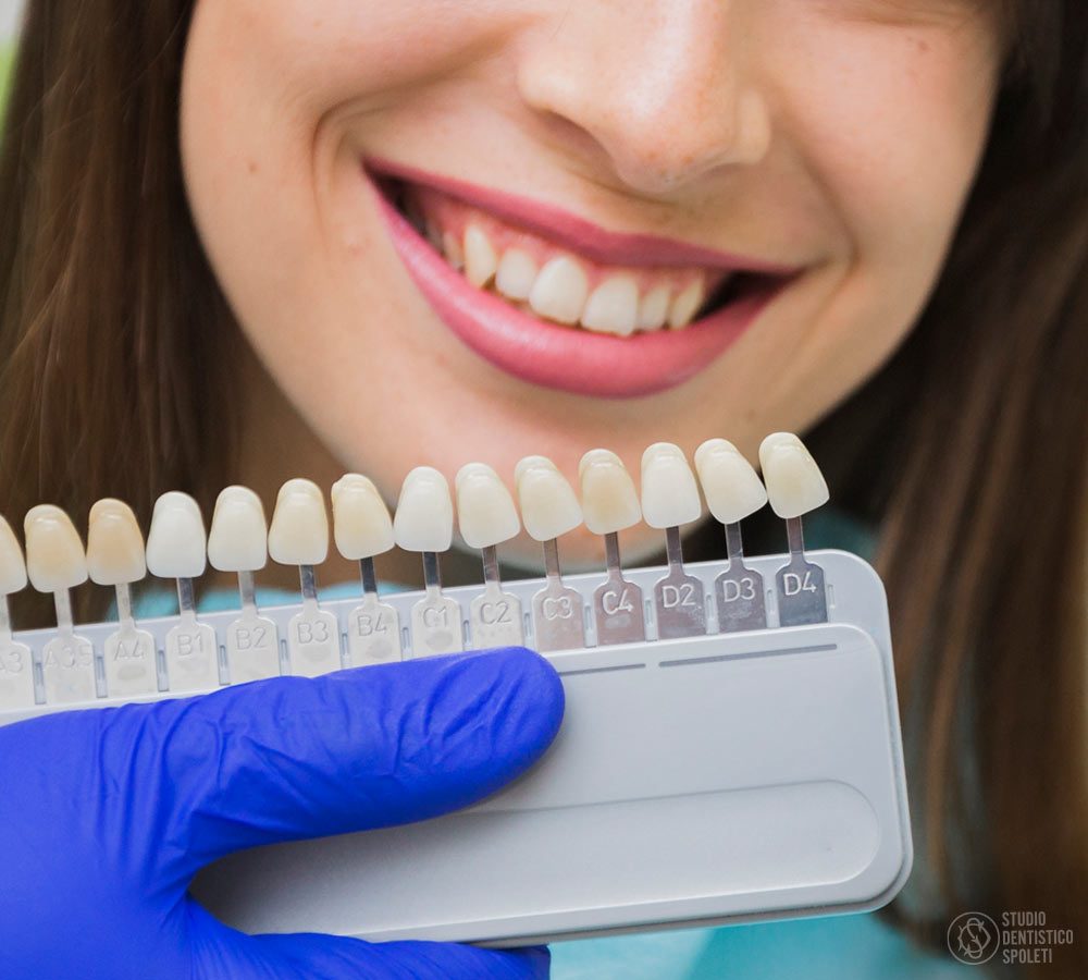Faccette dentali estetiche: immagine illustrativa
