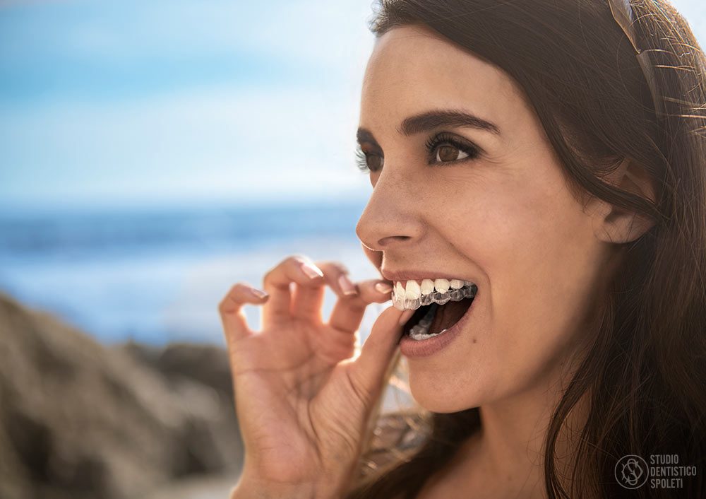 Allineamento dentale Invisalign: immagine illustrativa