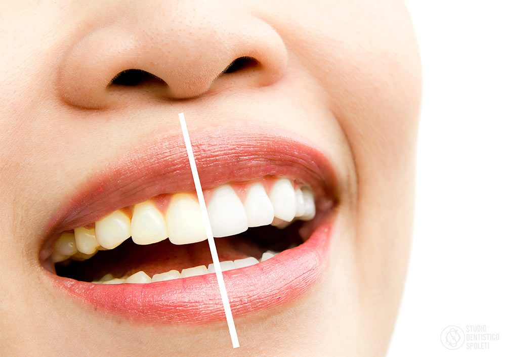 Sbiancamento dentale: immagine illustrativa